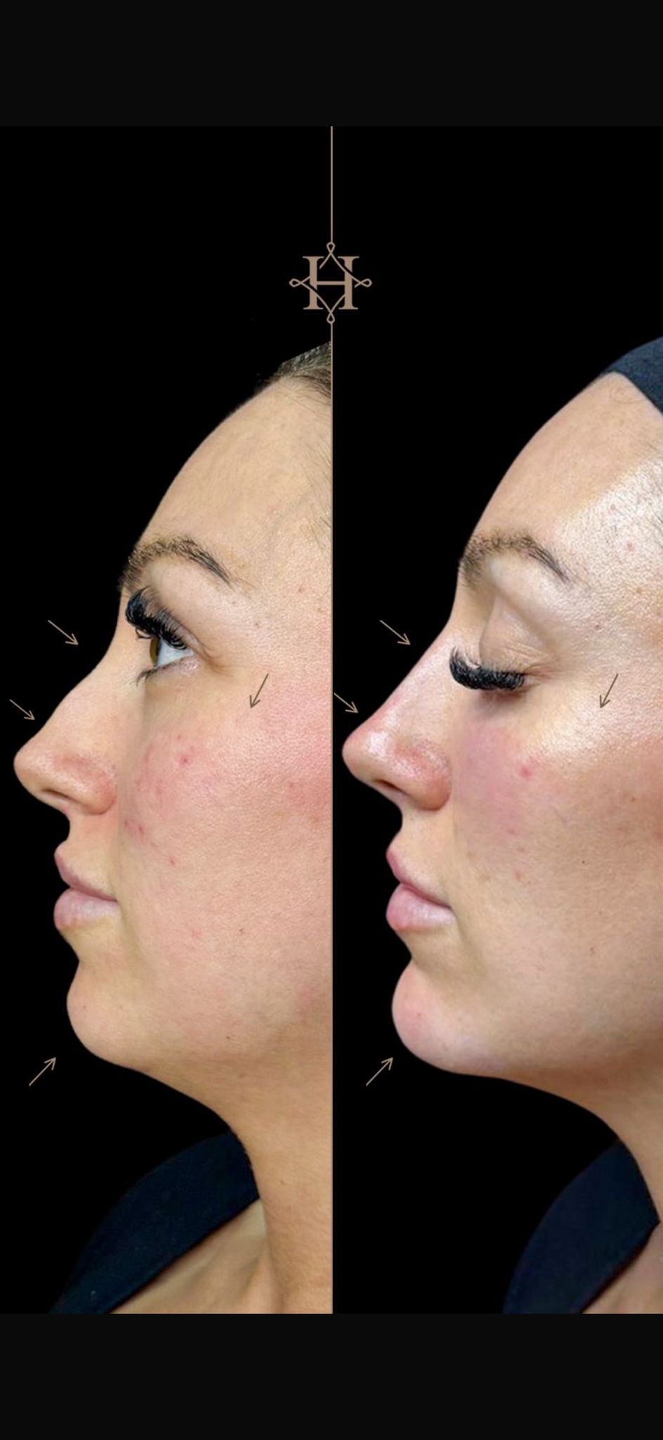 anti-aging-BA-4