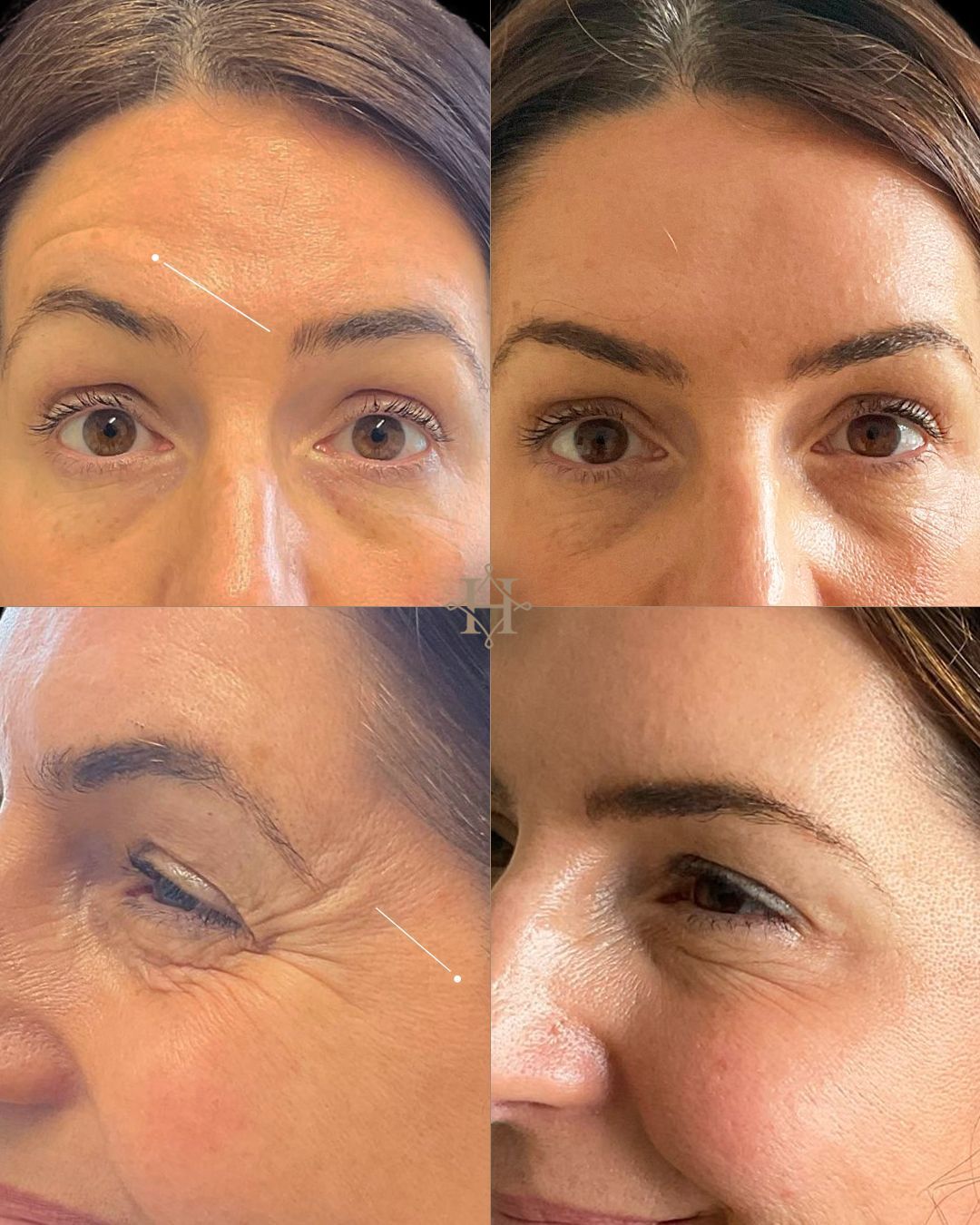 wrinkle-1