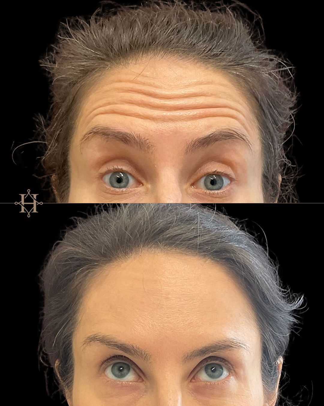 wrinkle-2