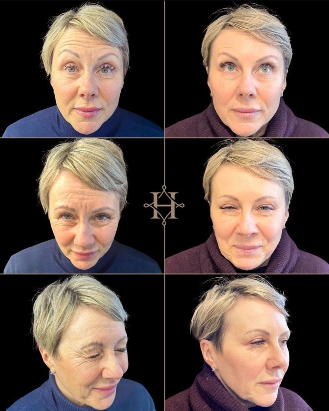 wrinkle-3