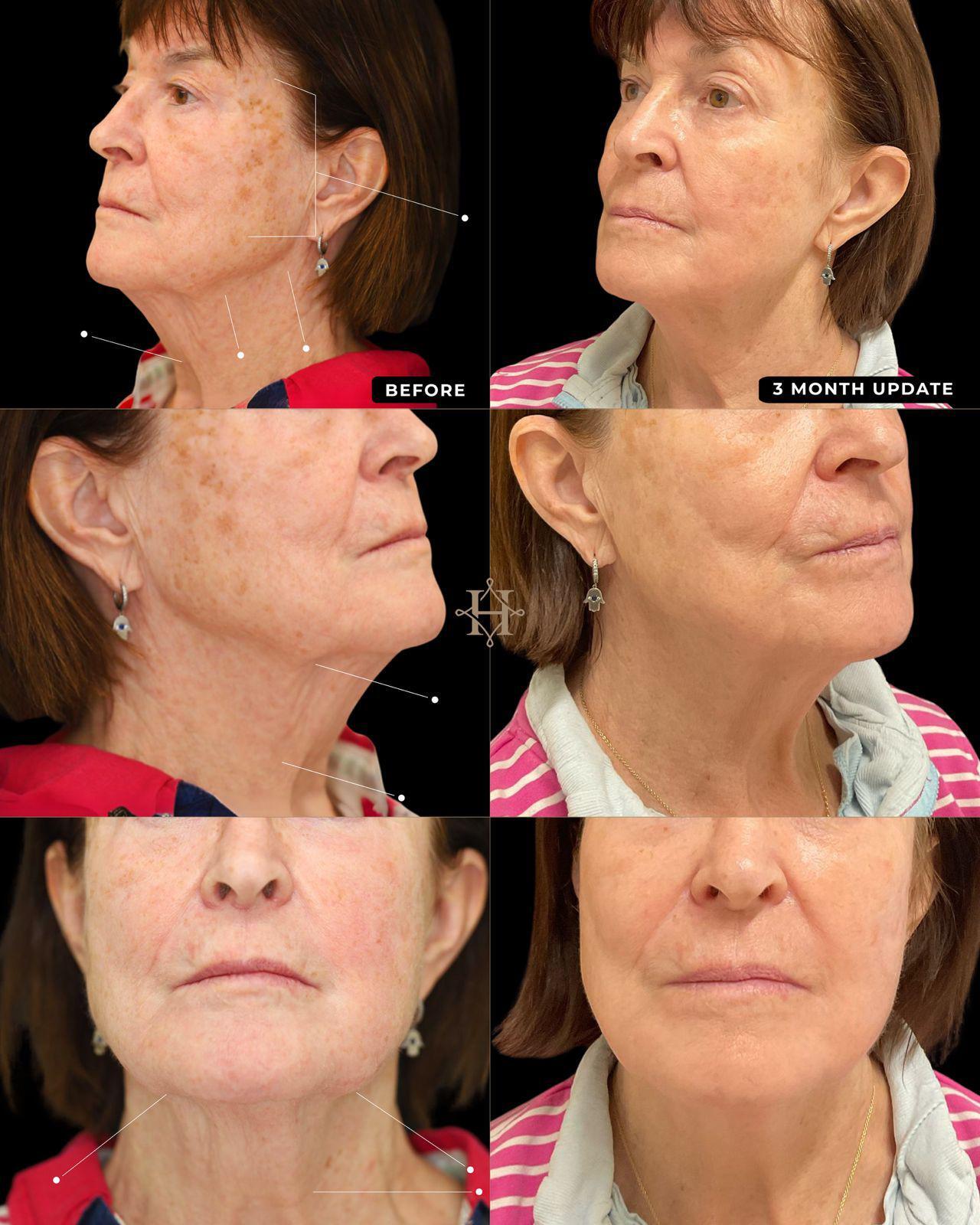 endolift 1