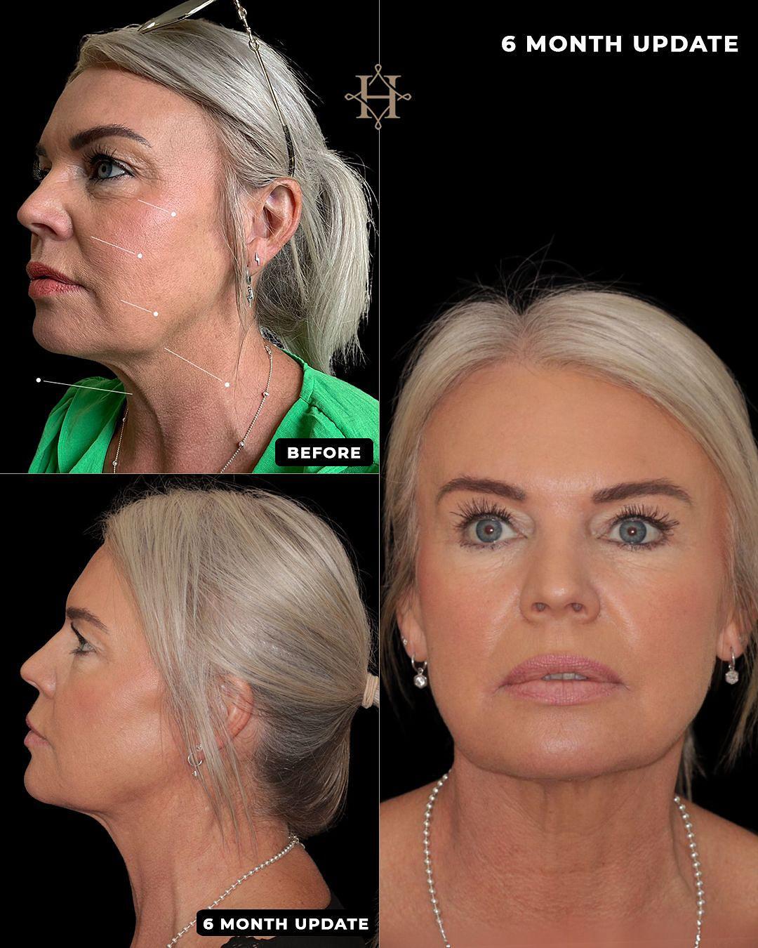 endolift 2