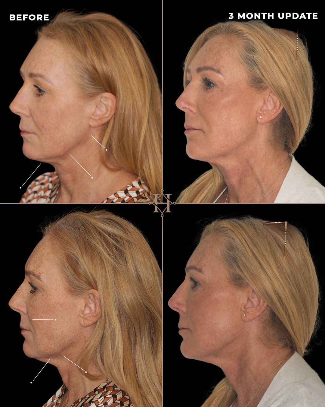 endolift 3