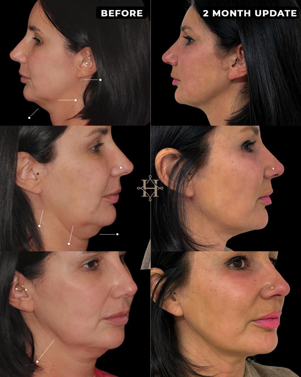 endolift 5